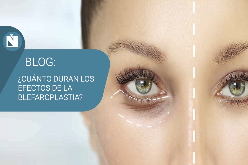 Cuánto duran los efectos de la blefaroplastia | Clínica Navarro Viana